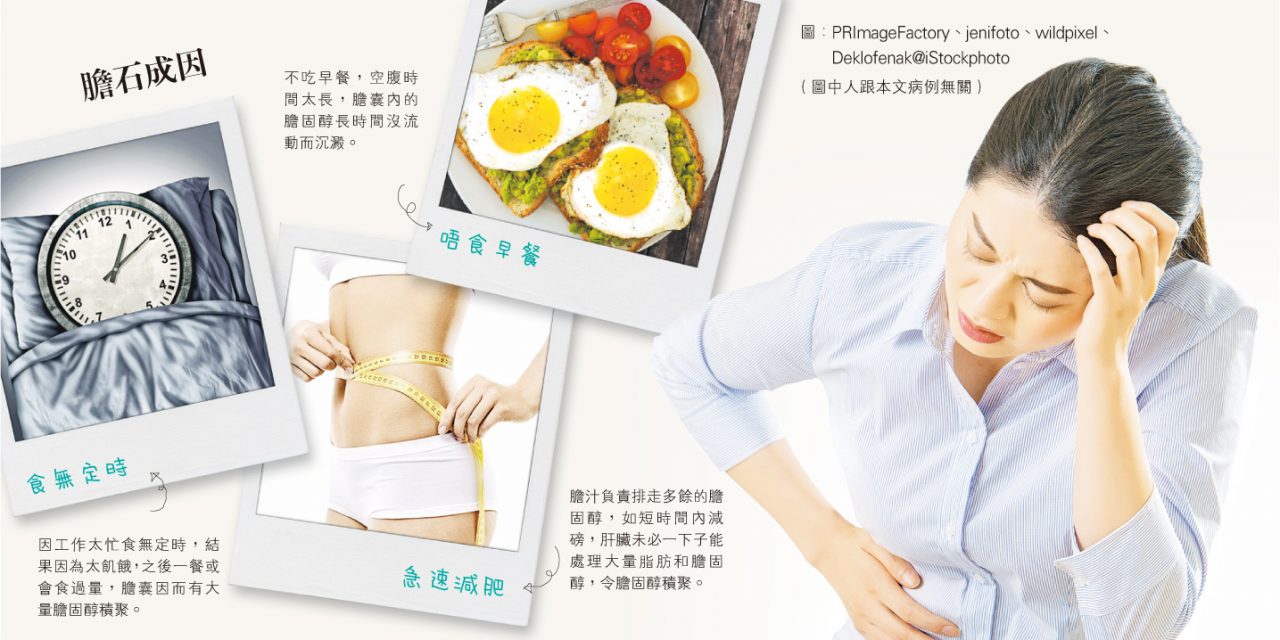 膽囊停工 膽固醇滯留 唔食早餐小心膽生石